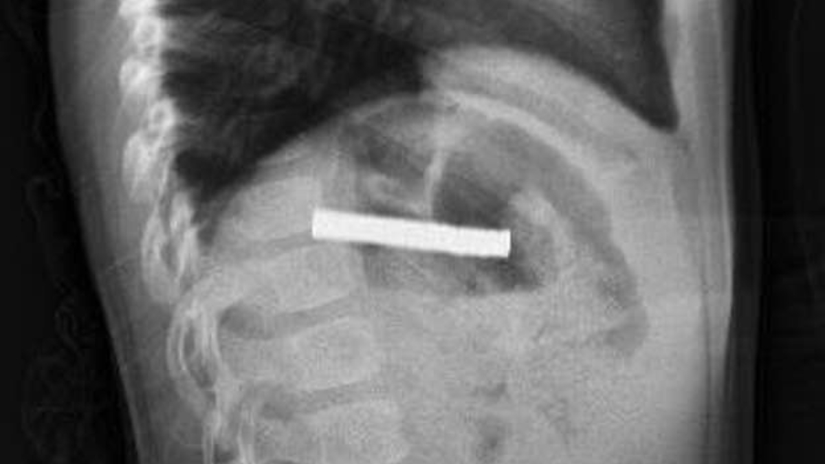 Elazığ’da çocuğun boğazından 19 adet mıknatıs çıkartıldı